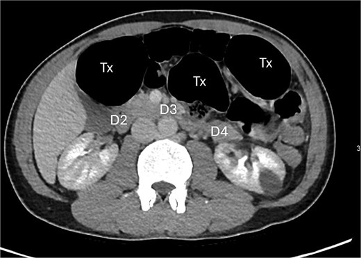 Posterior displacement of the duodenum (D4) due to herniated transverse colon.
