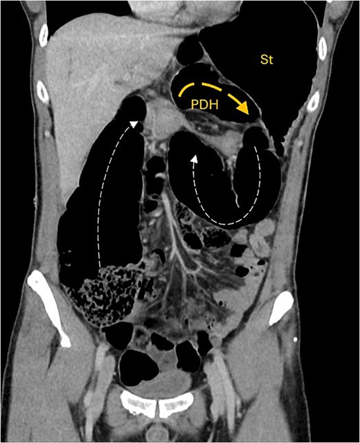 Coronal CT image showing obstructed transverse colon (Tx) path (small dash arrow), looping posteriorly through narrow hernia neck into anterior PDH containing Tx colon segment (wide dash arrow). Stomach (st) is distended.
