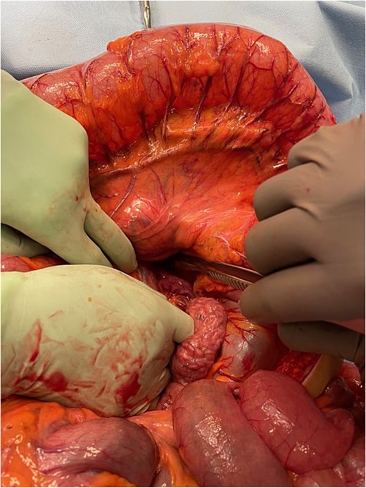 Intra-operative image demonstrating mesocolic defect through which the transverse colon had herniated.