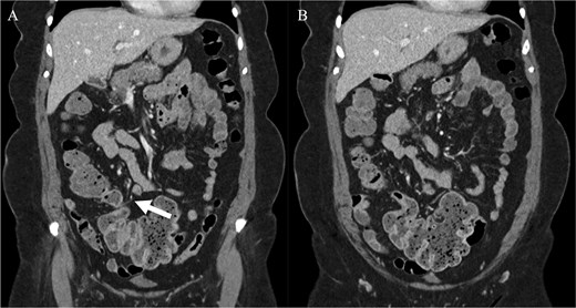 Computed tomography imaging of the patient pre-operatively. (A) The structure suspected to be the band partially obstructing the caecum is indicated by the arrow. (B) The distension of the caecum prior to the obstructing band is demonstrated.