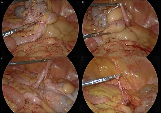 Intraoperative laparoscopic views. (A) The band is seen wrapped around the caecum causing the partial obstruction. (B) The band is untwisted from around the caecum and the Meckel’s diverticulum is revealed. (C) The Meckel’s diverticulum and its band are examined. (D) The band is transected.