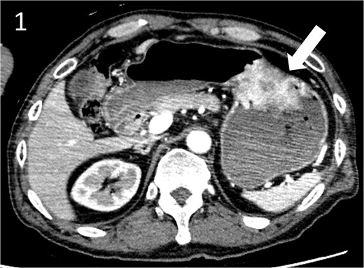 Contrast-enhanced computed tomography image showing a gastric hyper vascular mass on the lesser curvature (arrow).