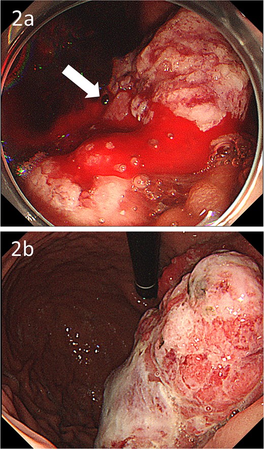 Gastroscopic images; (a) endoscopy showing a large type 1 oozing tumour (arrow); (b) endoscopy after embolization showing no bleeding.