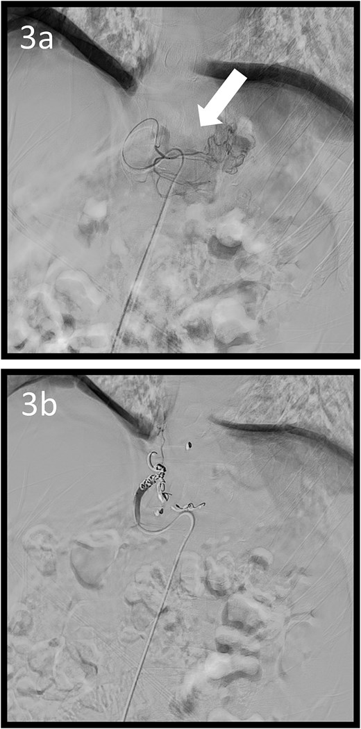 Angiographic images; (a) the left gastric arteriography showing tumour staining (arrow); (b) the left gastric artery was coil embolized.