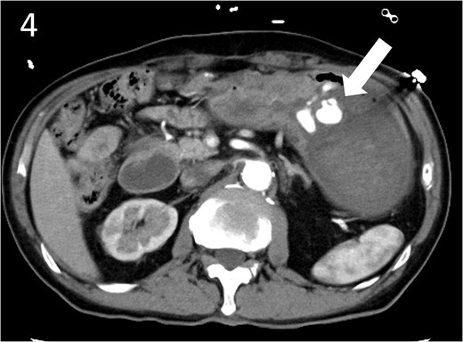 Contrast-enhanced computed tomography image showing active contrast extravasation in the stomach (arrow).