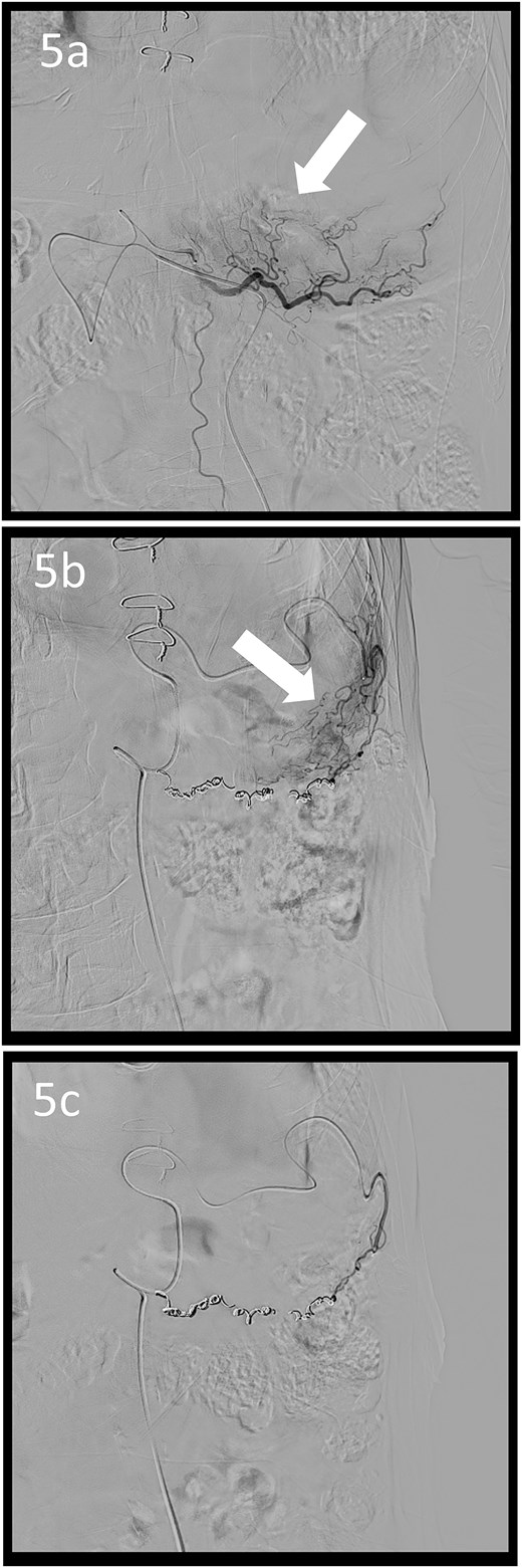 Angiographic images; the right (a) and left (b) gastroepiploic arteriograms showing tumour staining (arrows); (c) both arteries were coil embolized.
