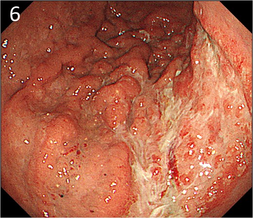 Endoscopy after embolization showing a type 4 tumour without bleeding.