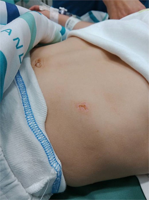 Photo upon initial assessment, revealing an abrasion and no apparent surrounding ecchymosis. Herniation not evident in supine position.