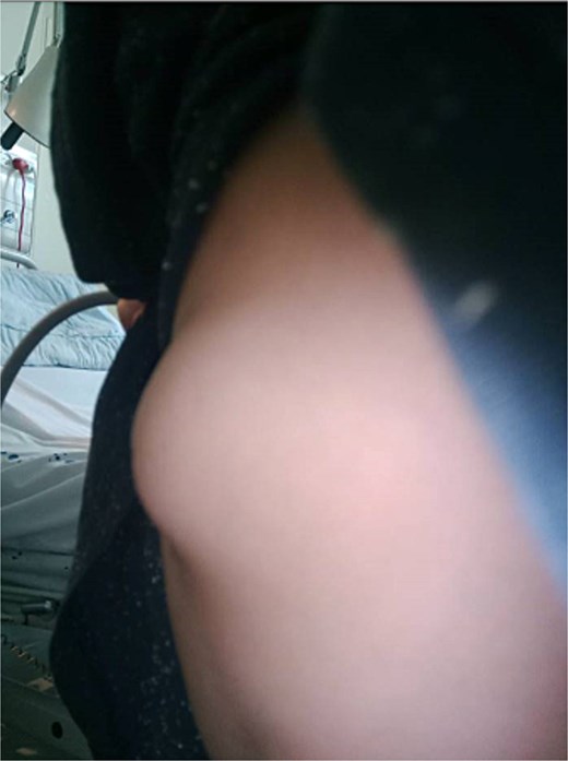 Photo of the hernia as seen when standing up, upon secondary assessment.