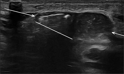 Sonographic imaging of the abdomen revealing a hernia defect (white line) and the hernial sac (white arrows).
