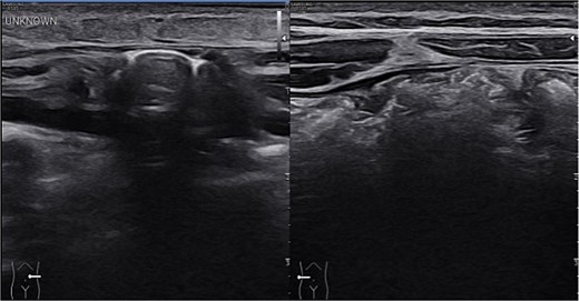 Sonographic imaging comparing left and right upper quadrant. On the left side intestinal content is seen within the hernia sac. On dynamic sonography peristalsis was apparent.