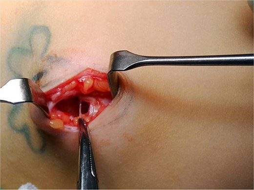 Open herniotomy, revealing a 1 cm defect in fascia and muscular wall, with no evidence of hernia sac or intestinal content.