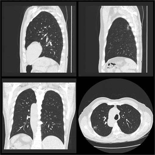 Pre-operative CT thorax, abdomen, pelvis.