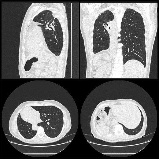 Post-operative CT thorax, abdomen, pelvis.