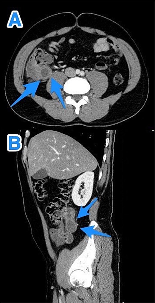 CT abdomen and pelvis with contrast—Axial (A) and sagittal (B) views highlighting a dilated, fluid-filled appendix with a maximum diameter of 2.2 cm and small peripheral calcifications (arrows).