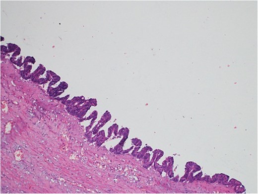 Light microscopy images of the appendix show low-grade dysplastic epithelium on the surface of the appendix (hematoxylin and eosin stain; 10×).