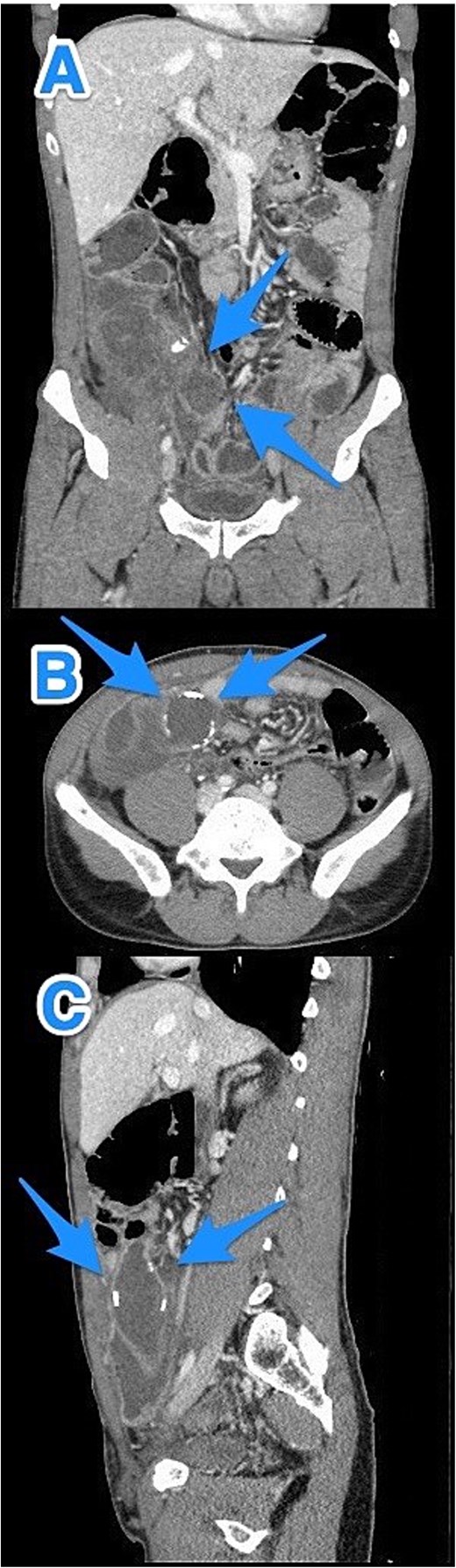 CT abdomen and pelvis with contrast: (A) coronal, (B) axial, and (C) sagittal views demonstrate a dilated, blind-ended structure in the right lower quadrant with incomplete circumferential calcifications and thick fluid content, consistent with an appendiceal mucocele (arrows).