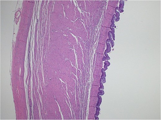 Light microscopy images of the appendix show low-grade dysplastic epithelium on the surface of the appendix (hematoxylin and eosin stain; 10×).