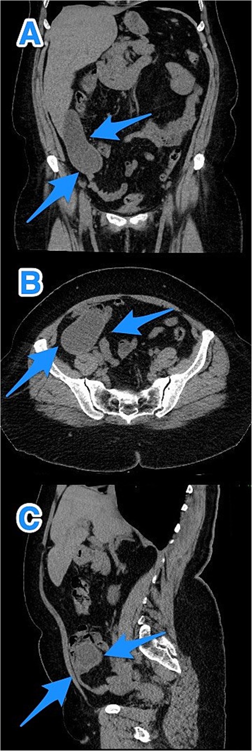 CT abdomen and pelvis with contrast: (A) coronal, (B) axial, and (C) sagittal views reveal an appendix measuring 22 cm in the right iliac fossa, with edematous wall thickening, minimal surrounding fat stranding, and an adjacent fluid collection measuring 3.3 × 1.8 × 8.5 cm, consistent with a perforated appendix (arrows).