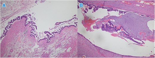 Light microscopy images of the appendix (A, B) show low-grade dysplastic epithelium on the surface of the appendix (hematoxylin and eosin stain; 4×).