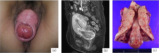 Examination findings. (a) Complete uterine prolapse with a mass protruding through the external cervical os. (b) Contrast-enhanced magnetic resonance imaging (T1-weighted) shows a submucosal fibroid originating from the anterior uterine wall descending through the cervical canal. (c) Resected specimen shows uterine cross-section showing a 3-cm stalked fibroid extending through the cervical canal.
