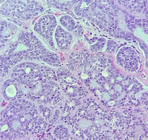 The tumor is composed of dual cell populations of basaloid epithelial cells and myoepithelial cells, arranged in characteristic cribriform and tubular growth patterns.