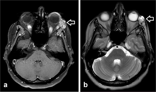 Orbit MRI showed lobulated well-defined lesion, hyperintense to intermediate on T2W (a), hypointense on T1W (b) structures with cystic changes measuring 2 × 1.5 cm and 2 × 1.2 cm. After IV contrast administration they showed heterogeneous moderate enhancement.