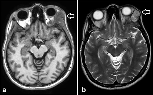 Orbit MRI showed a lobulated, well-defined lesion, hyperintense to intermediate on T2W (b) and hypointense on T1W (a) structures with cystic changes, measuring 2.3 × 1.9 cm and 2.6 × 1.6 cm, compared with the previous study, the lesions have increased in size.