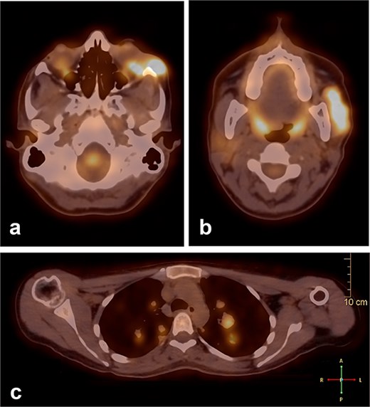 A PET scan revealed hypermetabolic malignant irregular soft tissue thickening within the lateral periorbital side of the left eye (a), indicating a recurrence of ACC of the left eye, and a new hypermetabolic irregular soft tissue mass in the left parotid gland (b). Numerous bilateral scattered pulmonary nodules were noted (c).