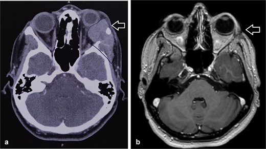 (a) CT scan showed left orbital mass with both solid enhancing and cystic components. The epicenter of the mass appears to be in the left lacrimal gland. (b) MRI postoperative that showed complete tumor excision.