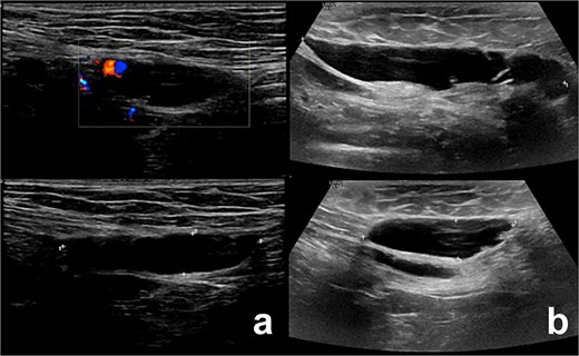 Illustrates the ultrasound findings for the two patients, highlighting the presence of the canal of Nuck cyst (case 1: a, case 2: b).