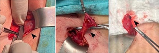 Intraoperative images showing the cyst, highlighted by the head arrow.