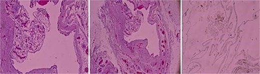 Three histopathologic microscopic images of the cyst.