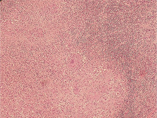 Histopathological slide section of biopsy specimen taken from the right axillary node lesion showing caseating granulomatous inflammation, consistent with tuberculosis.