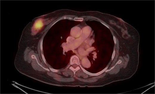 PET-CT axial view of the thorax, indicating a metabolically active lesion in the right breast.