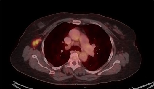 PET-CT axial view of the thorax, indicating a metabolically active lesion in the right axillary region, involving the right axillary lymph nodes.