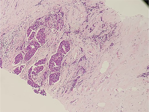 Histopathological slide section of biopsy specimen taken from the right breast lesion showing invasive ductal breast carcinoma, NOS, grade II based on the Nottingham grading system.