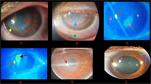 (a) Day 1: Blue arrow—Disk-shaped edema with endotheliitis; green arrow—Ciliary conjunctival injection; yellow arrow—Wessley immune ring; red arrow—DMF; Brown arrow—Corneal reflection. (b) Day 2 post admission: Blue arrow—Disk-shaped edema with endotheliitis remained unchanged; green arrow—Ciliary conjunctival injection improved. (c) Purple arrow—Punctate epithelial erosions; Brown arrow—Corneal reflection. (d) Black arrow—Corneal epithelial defect; Brown arrow—Corneal reflection. (e) Significant improvement of corneal edema and endotheliitis; Brown arrow—Corneal reflection. (f) Dilated pupils for fundus exam; white arrow—Stromal scar; Brown arrow—Corneal reflection.