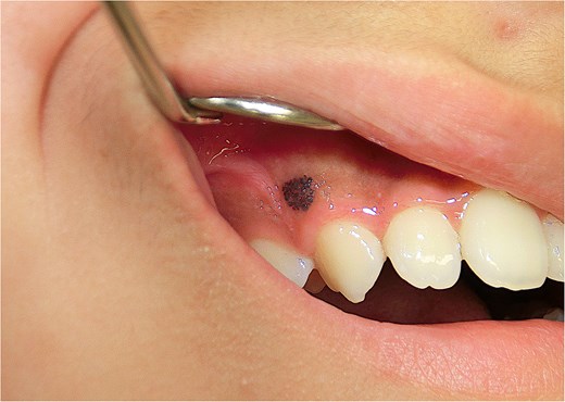 Macroscopic view of the lesion. A cluster of tiny black papules was observed in the gingiva just above the right canine tooth.
