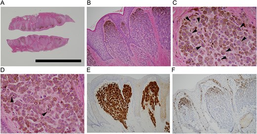 (A) Whole-mount view of the gingival lesion. The incision biopsy sample was halved along the longitudinal axis and mounted vis-à-vis. Note that the lesion is slightly raised symmetrically, and foci of nevus cell clusters are present beneath the surface epithelium. (Solid bar = 3 mm). (B) Histology of the biopsied lesion. In each focus of nevus cell clusters, the nevus cells near oral cavity were endowed with melanin pigment (HE, ×100). (C) In the pigmented cell clusters, multiple mirror-image bi-nucleated cells were noted (arrowheads). Nuclear inclusion bodies were also seen (HE, ×400). (D) In the pigmented cell foci, apoptosis bodies were observed (arrowheads). Nuclear inclusion bodies were also seen in this field (HE, ×400). (E) Pigmented cells were uniformly stained with S-100 (×100). (F) Pigmented cells were scarcely stained with Ki-67. Only basal layer cells of stratified squamous cell epithelium were labelled (×100).