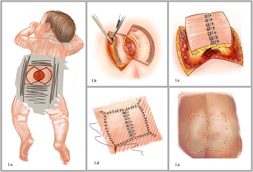 Preoperative planning. (a) Coverage defect in the lower lumbar region secondary to the resection of a myelomeningocele. (b) Diagram of the keystone perforator island flap design. (c) Advancements flaps. (d) Surgical wound closure. (e) Postoperative outcome with immediate defect closure.