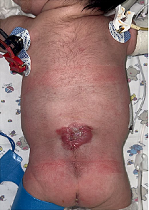 A fibrinoid mycotic eschar in the dorsolumbar region.