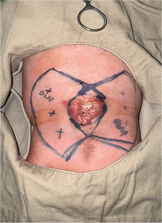 Type III KDPIF design.