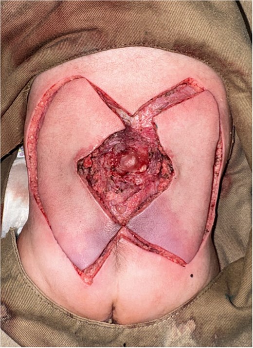 Defect after escharectomy and type III KDPIF dissection.