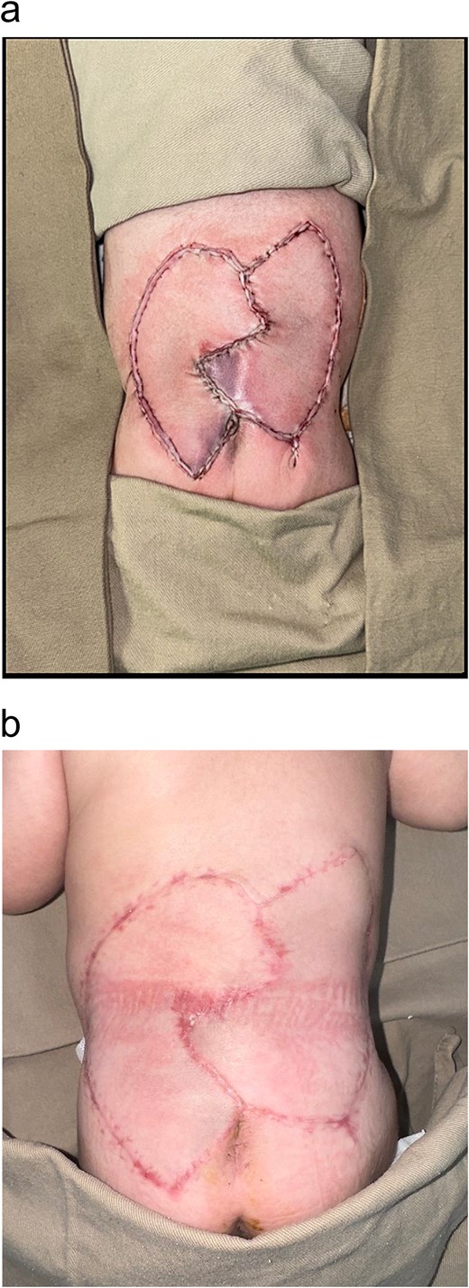 (a) Immediate reconstruction with a type III KDPIF with a Z-shaped closure variation. (b) 3 months postoperative follow-up.