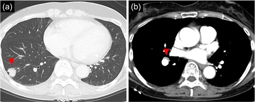 Chest computed tomographic image. (a) An 18 mm size nodule is detected in the S9 region of the right lower lobe. (b) An enlarged lymph node (#11iLN) with fluorodeoxyglucose accumulation is located anterior to the basal segment of the pulmonary artery.