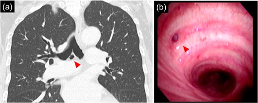 (a) 9 mm size bronchial diverticulum located at the subcarinal region. (b) Bronchial diverticulum opening in the right main bronchus and two rings distal to the carina.