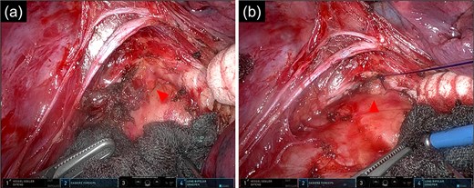 Intraoperative images of the inferior mediastinal region. (a) Image of dissecting the bronchial diverticulum and mediastinal lymph nodes. (b) Image of a bronchial diverticulum after ENDOLOOP® PDS II Ligature ligation. Arrowhead: bronchial diverticulum.