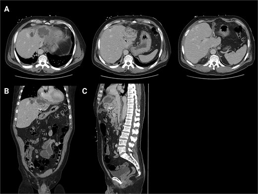 Initial CT scans. (A) Axial images progressing from superior to inferior. These show the hepatic abscess as well as the small bowel limb anastomosed to the biliary tree. (B) The same scan, but in a coronal view. (C) The same scan, but from a sagittal view. This view again illustrates the limb of a small bowel anastomosed to the biliary tree. Surgical clips are seen in the gall bladder bed.