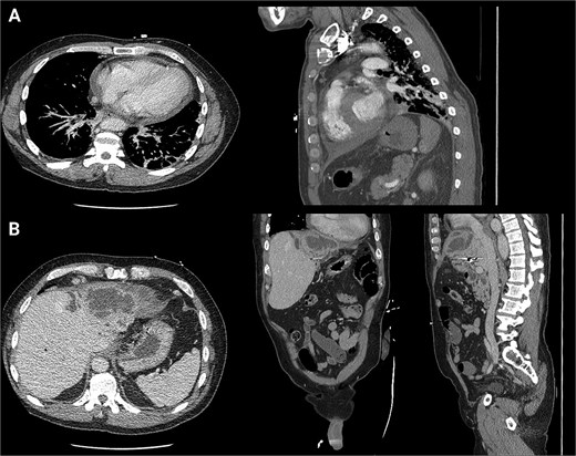 First readmission CT scans. (A) CTA chest images in the axial and sagittal planes illustrating the newly developed pericardial effusion. (B) CTA abdomen/pelvis images in the axial, coronal, and sagittal planes. These illustrate the abscess increasing in size.